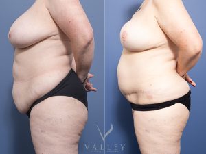 8 brest recon with DIEP and nipple recon 15 months side - Breast Reconstruction Gallery 12