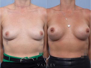 8 front tat - Breast Augmentation Gallery 16