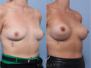8 ob tat - Breast Augmentation Gallery 17