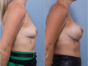 8 side tat - Breast Augmentation Gallery 18