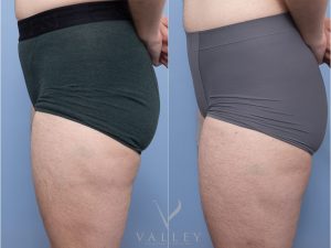 9 side tat - Thigh Lift Gallery 3