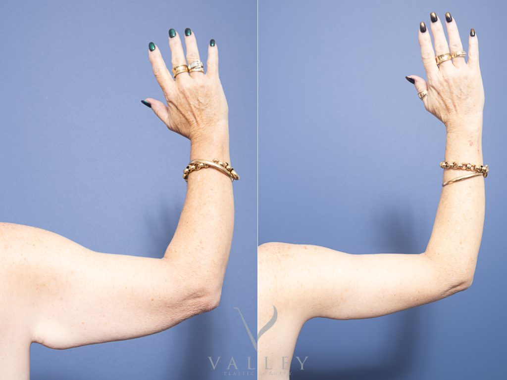 ARM BACK - Brachioplasty - Arm Lift Gallery 11