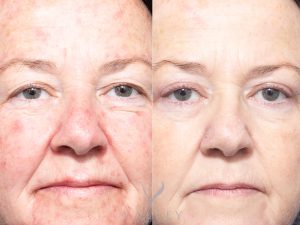 EYES FRONT - Eyelid Surgery/Upper Blepharoplasty Gallery 17