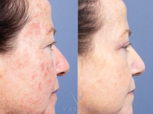 EYES SIDE - Eyelid Surgery/Upper Blepharoplasty Gallery 19