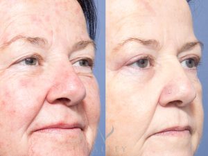 Eyes ob - Eyelid Surgery/Upper Blepharoplasty Gallery 18