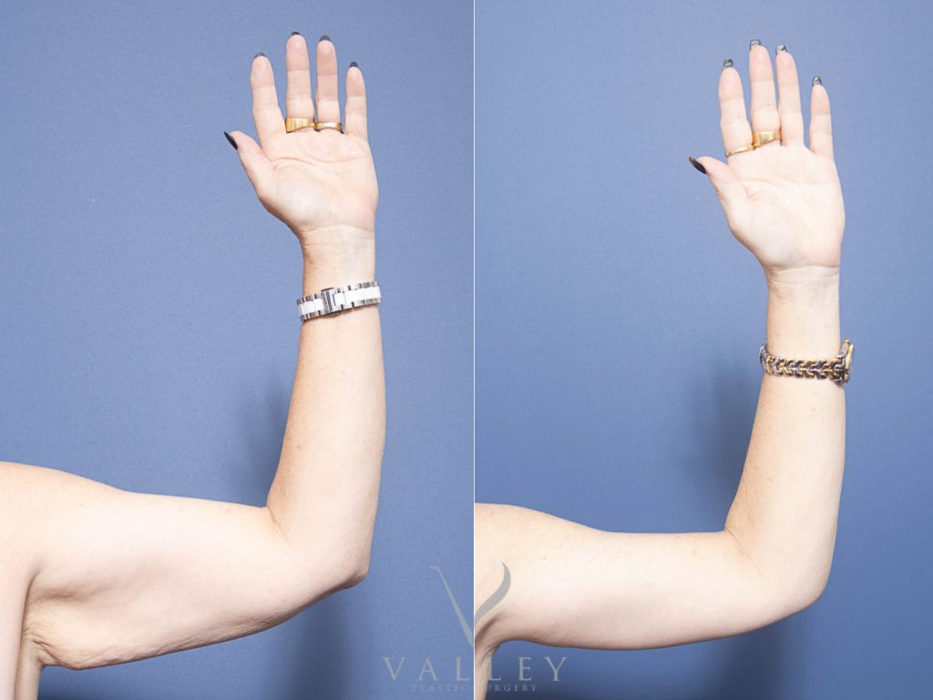 arm front - Brachioplasty - Arm Lift Gallery 12