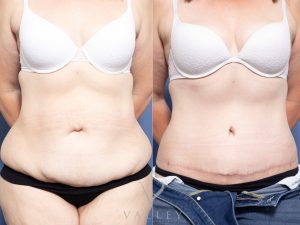 front 2 - Belt Lipectomy Gallery 24