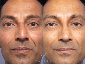front new - Rhinoplasty Gallery 59