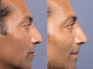 side new - Rhinoplasty Gallery 61