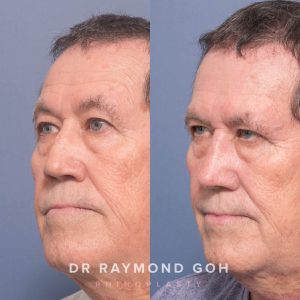 0A0C7F80 6F44 4E5F ABBA 72ADB90AB0FE - Rhinoplasty Gallery 132