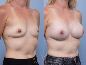12 ob - Breast Augmentation Gallery 47