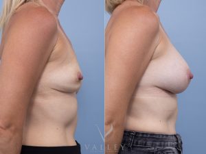 12 side - Breast Augmentation Gallery 48