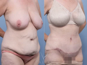 13 ob blur - Abdominoplasty Gallery 65