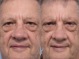 14 front - Eyelid Surgery/Upper Blepharoplasty Gallery 37