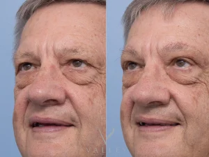 14 ob - Eyelid Surgery/Upper Blepharoplasty Gallery 36