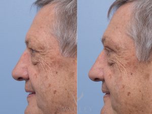 14 side - Eyelid Surgery/Upper Blepharoplasty Gallery 35