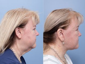 2 facelift 1y WS side - Facelift Gallery 13