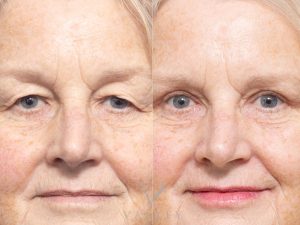 25 front - Eyelid Surgery/Upper Blepharoplasty Gallery 32
