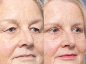 25 ob - Eyelid Surgery/Upper Blepharoplasty Gallery 33