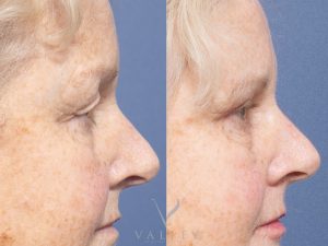 25 side - Eyelid Surgery/Upper Blepharoplasty Gallery 34