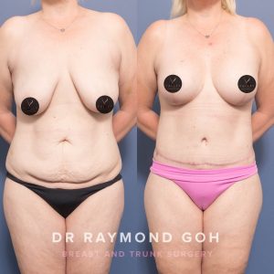 2C925BEB 7565 4C2D B1D0 3A5848643FC7 - Breast Augmentation Gallery 49
