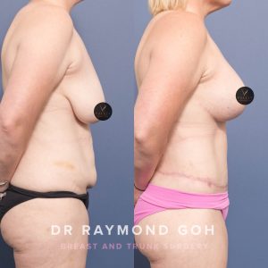 2EB0A3C1 D02E 4431 8B30 54883346858D - Breast Augmentation Gallery 51