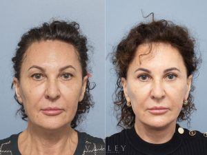 3 facelift lower bleph 1y WS front - Facelift Gallery 5