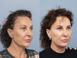 3 facelift lower bleph 1y WS oblique - Facelift Gallery 6