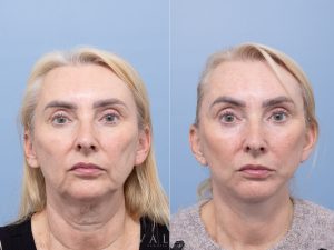 4 face rhino 4m ws front - Facelift Gallery 14