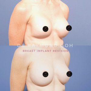4A16A21E 3E1A 4393 8FB9 39DD34CDDB82 - Breast Augmentation Gallery 54