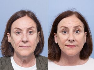 5 face necklift WS front - Facelift Gallery 17