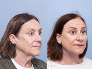 5 face necklift WS oblique - Facelift Gallery 18