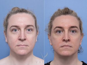 6 face 7m Ws front - Facelift Gallery 20