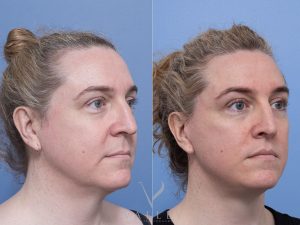 6 face 7m Ws oblique - Facelift Gallery 21