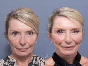 7 bleph fat grafting co2 septoplasty ws front - Eyelid Surgery/Upper Blepharoplasty Gallery 26