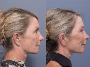 7 bleph fat grafting co2 septoplasty ws side - Eyelid Surgery/Upper Blepharoplasty Gallery 28