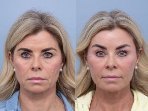 8 consent to all front - Eyelid Surgery/Upper Blepharoplasty Gallery 29
