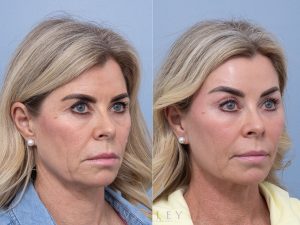 8 consent to all oblique - Eyelid Surgery/Upper Blepharoplasty Gallery 30