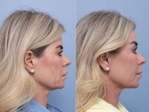 8 consent to all side - Eyelid Surgery/Upper Blepharoplasty Gallery 31