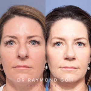 9B9EC243 97E5 414F 97D5 C28363A0E4A0 - Rhinoplasty Gallery 158