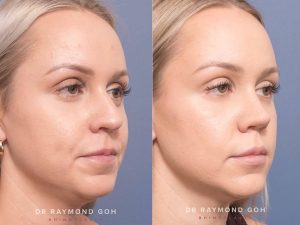 u.o - Rhinoplasty Gallery 189